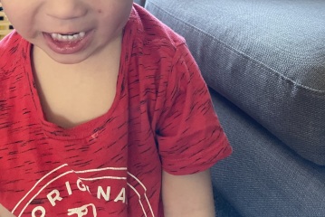 My 3 year old is getting acne