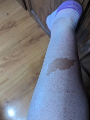 Noticed DD's birthmark for the first time today, DH worried it's going to be big
