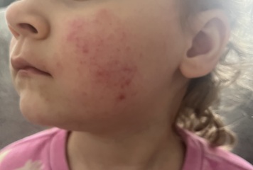 Does anyone know what this rash is?