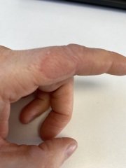 Psoriasis or eczema?