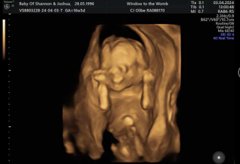 1:90 Chance My Child Could Have Downsydrome.