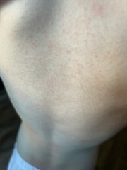 What’s this rash on my 5 year old (pic included)