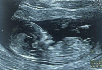 Going down a rabbit hole with nub theory (yes I know I am crazy) - Is this definitely a boy!