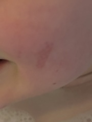 Bruise on kids face