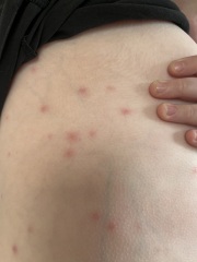 If this isn’t chicken pox, any ideas what it is?