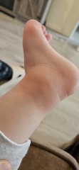 Swollen feet/ankles and blotchy skin?