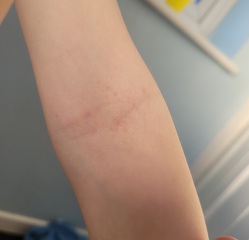 Does this look like scabies?