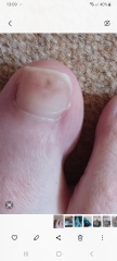 Worrying mark on toe