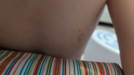 Could this be chicken pox?