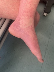 Anybody’s child have these symptoms??