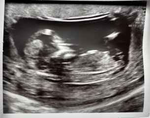 Boy or girl