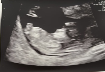 Ultrasound at 16w - can it be wrong