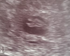 Small Gestational Sac