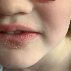 What is this rash/dry skin