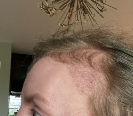 I’ve just had a hair transplant AMA