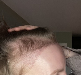 I’ve just had a hair transplant AMA