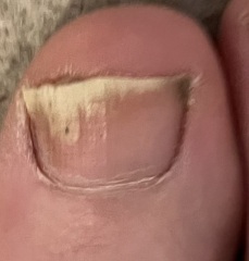 Warning - toenail photo