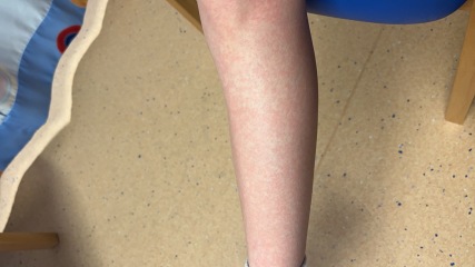 Help me identify this rash