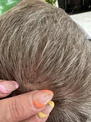 Anyone au fait with suspicious moles? Photos attached