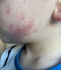 What’s this rash on my 5 year old (pic included)