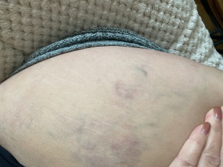 Blood clots in leg ??