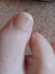 Worrying mark on toe