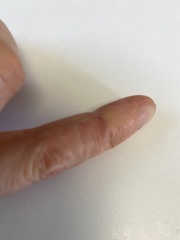 Psoriasis or eczema?