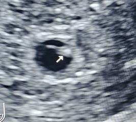 Small Gestational Sac
