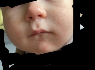 15 month old and sudden pimply rash on face
