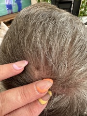 Anyone au fait with suspicious moles? Photos attached