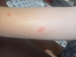 Is this chickenpox?