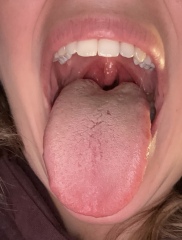 Tonsillitis or quinsy??? Help