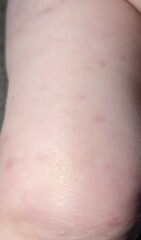 Non fading rash 10 month old - no fever/illness