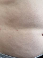 If this isn’t chicken pox, any ideas what it is?