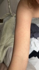 Help me identify this rash