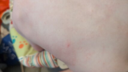 Could this be chicken pox?