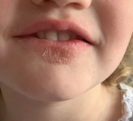 What is this rash/dry skin