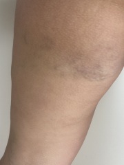 Blood clots in leg ??