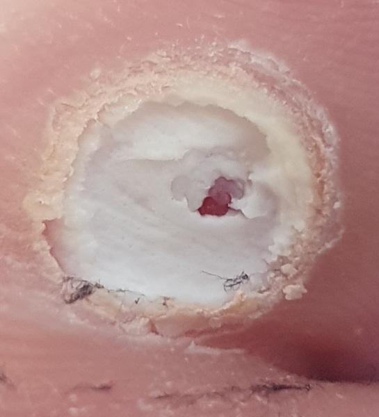 Is this a verruca still?? Picture attached