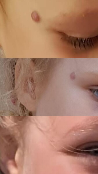 Daughters Hemangioma (with pic)