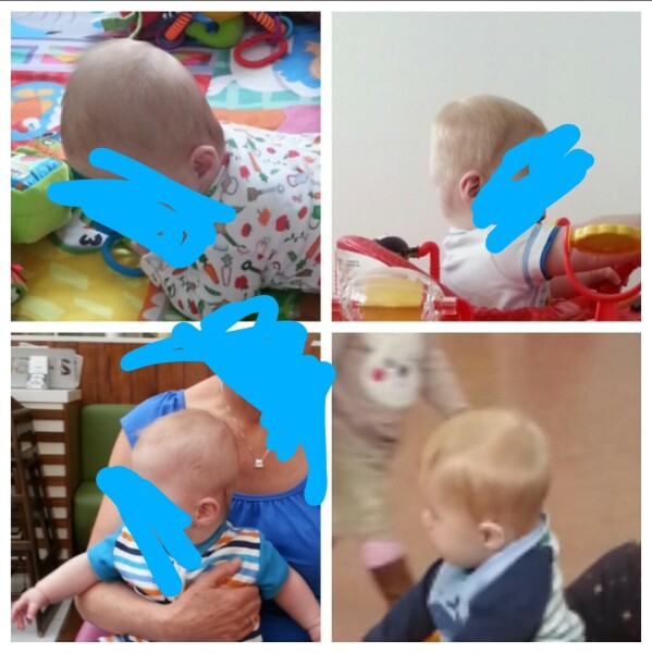 Severe plagiocephaly baby