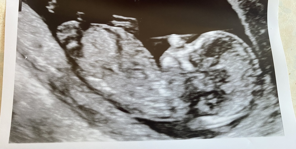 Girl nub? 13 weeks