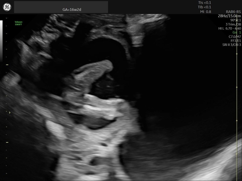 Can anyone tell which placenta variation this is?