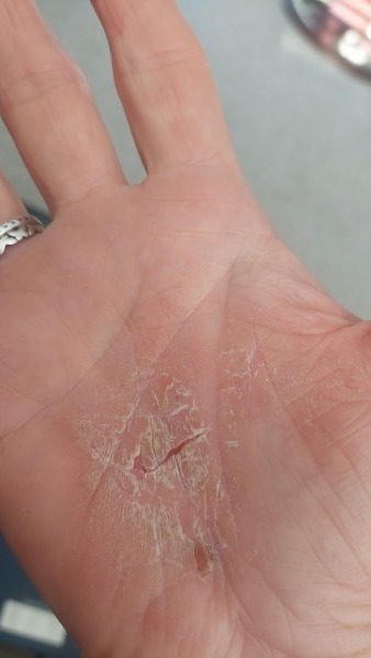 Cracked palms