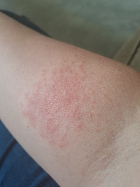 What's this rash?