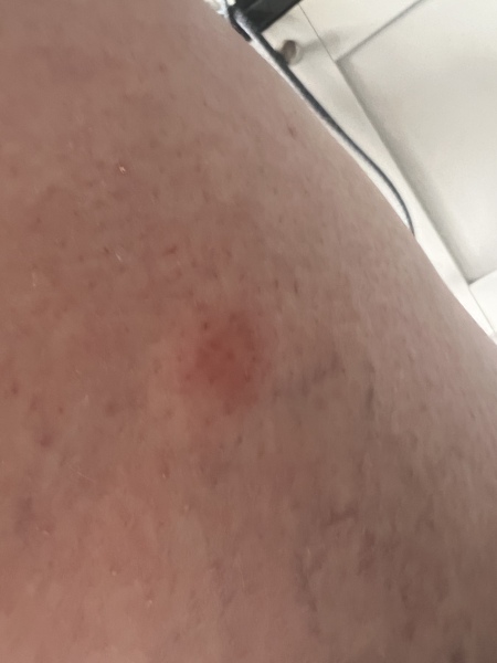 Help identify bites!