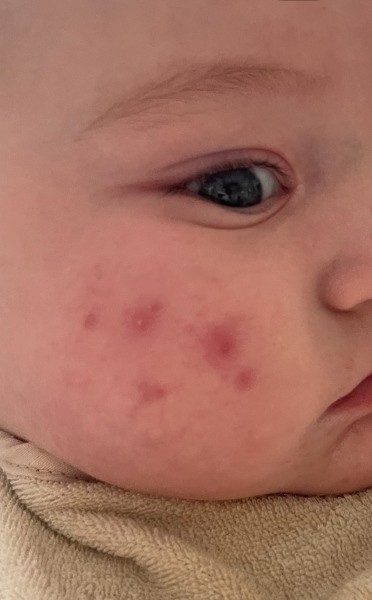Infantile Acne / Baby Acne at 5 months