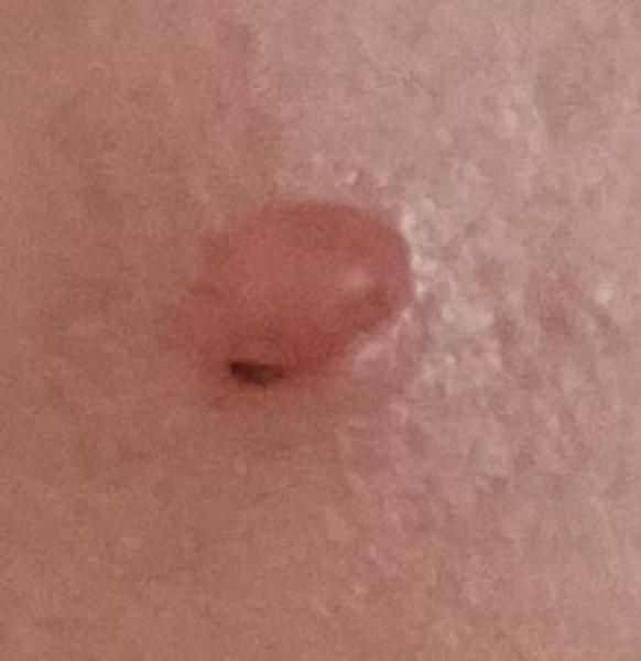 Weird insect bite on face? (Piccy included)