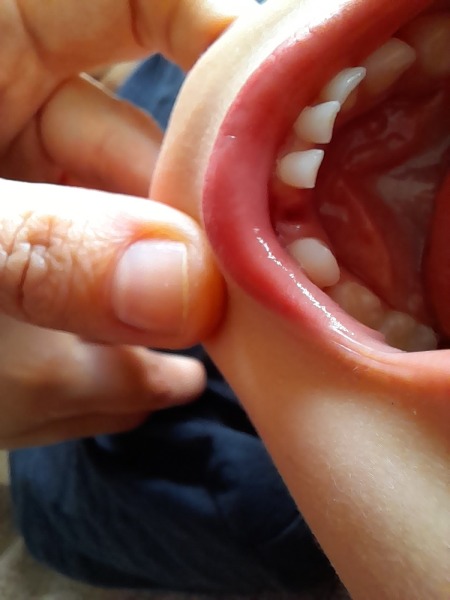 Losing milk teeth at 4