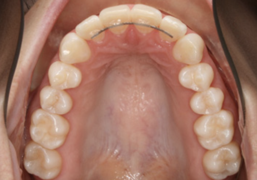 Removing invisalign fixed retainers?